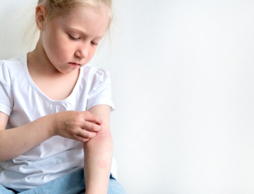 Understanding Histamine Foods and Your Eczema