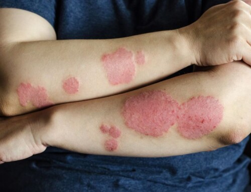 Discoid Eczema – Demystifying The”Coin-Sized” Rash And Its Link To Your Liver!